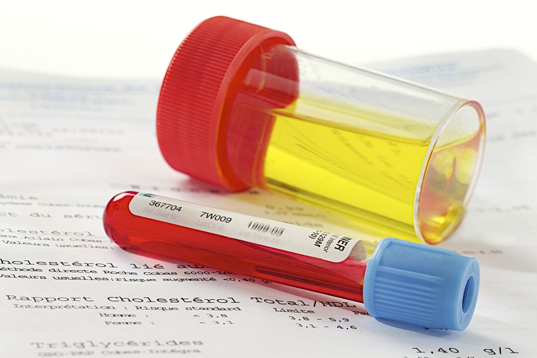 Un esame del sangue e delle urine aiuterà a determinare la presenza di prostatite.
