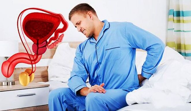 Dolore lombare dovuto alla prostatite