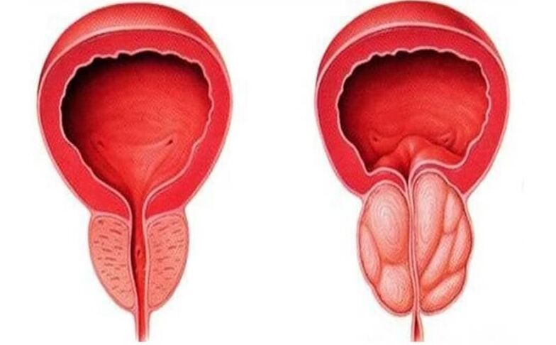 prostata sana e infiammata con prostatite