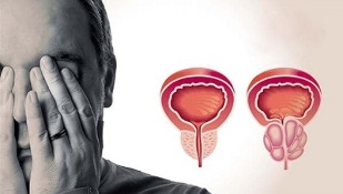 Cause di prostatite negli uomini