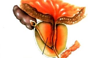 Cos'è la prostatite negli uomini