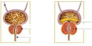 Tipi e forme di prostatite negli uomini