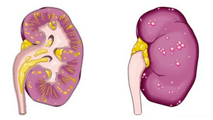 cosa causa la prostatite acuta