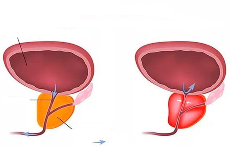 prostata normale e infiammata