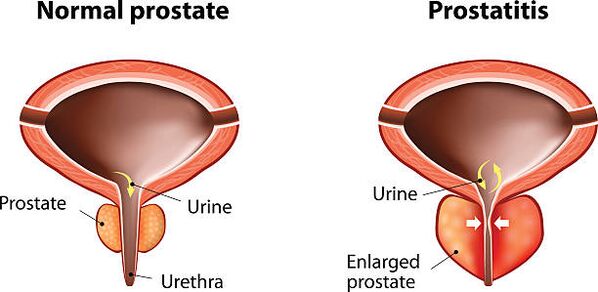 prostata normale e infiammata