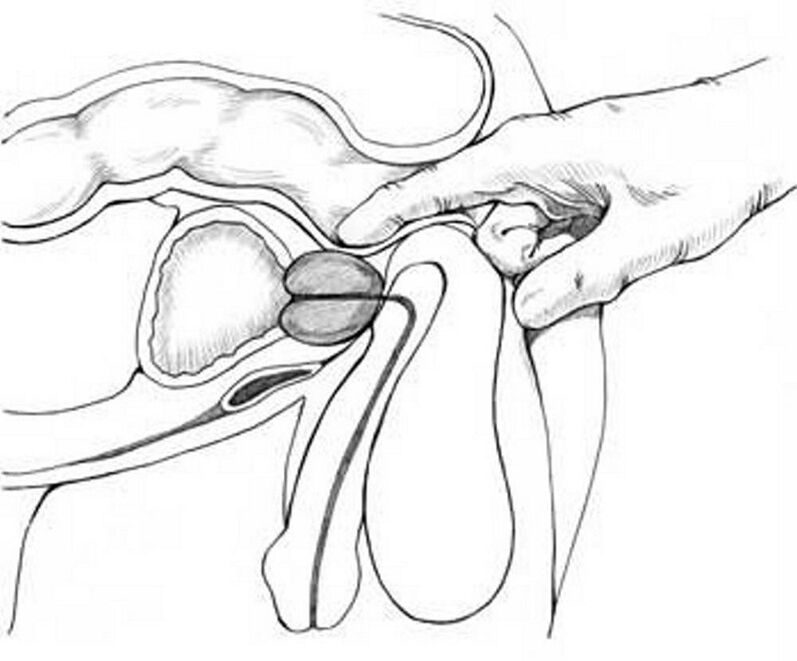 Massaggio prostatico per prostatite cronica