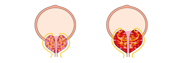 prostata sana e infiammata con prostatite