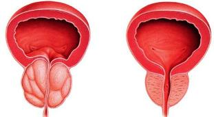la differenza è che il paziente e la salute della prostata